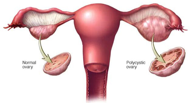 PCOS/PCOD Treatment
